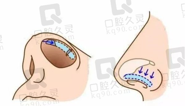 福州薛克墘鼻子做得怎么样