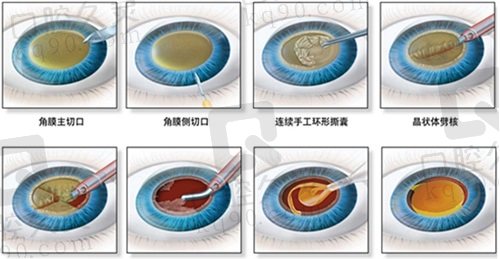 青岛鲁东眼科医院免费白内障手术