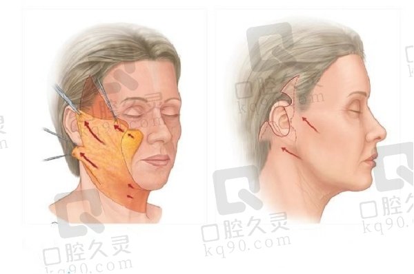 南京小拉皮手术谁做得好