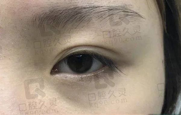 长春中妍美容双眼皮价格