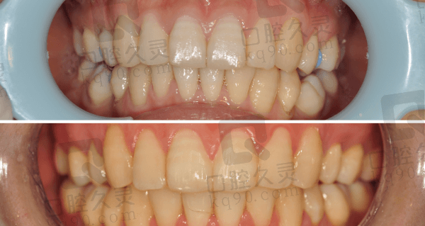 厦门登特口腔医院的正畸价格真的很实惠