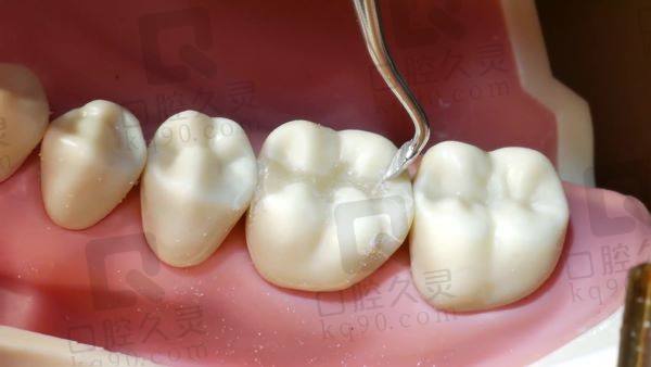 哈尔滨优诺口腔医院美国3M-Z350树脂补牙怎么样