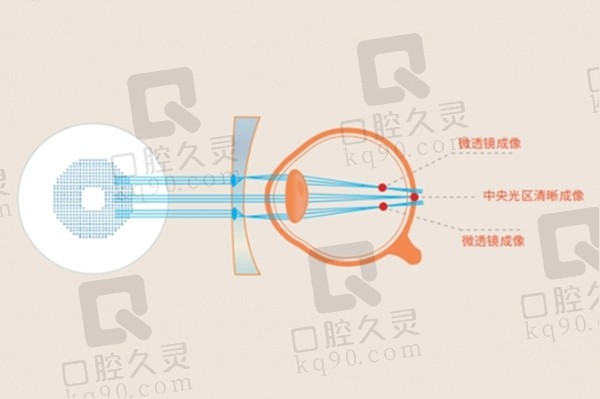 离焦镜片的优缺点和危害