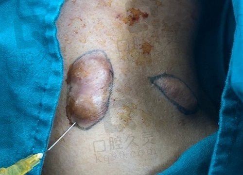 昆明昆大疤痕醫(yī)院好不好？