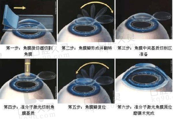 柳州赋盈眼科医院近视手术价格表