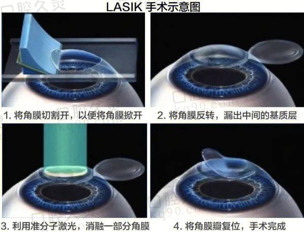 柳州赋盈眼科医院近视手术怎么样