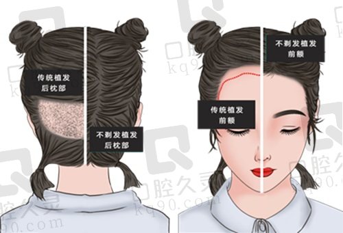 北京植发多少钱一个毛囊？