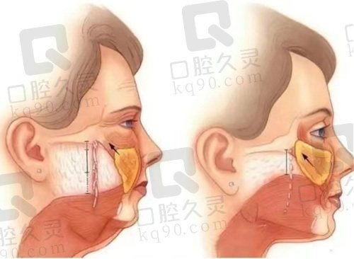 北京黄寺Caw小切口面部提升术怎么样？