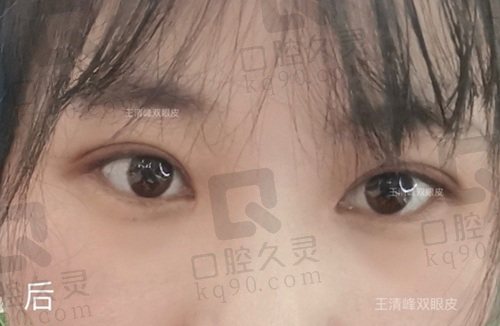 北京艺星王清峰双眼皮怎么样？