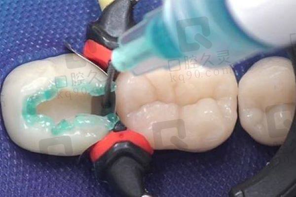 深圳格伦菲尔口腔医院补牙医生
