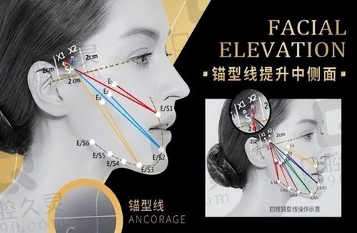 成都素美筋膜提升手术价格1万元起