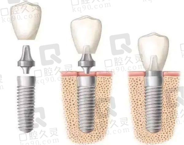 上海万维普惠口腔医院种植牙怎么样