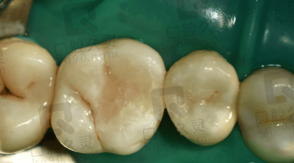 青岛维乐口腔补牙便宜且技术好