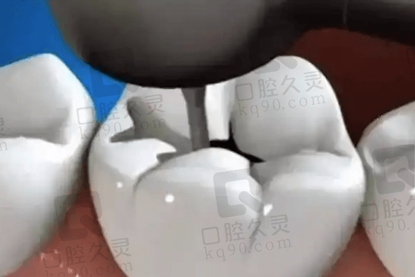 杭州团圆口腔医院美国Z350树脂补牙怎么样？