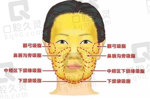 哈尔滨羽禅杨宇梓医生做面部吸脂怎么样？