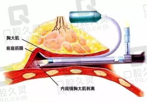 广州中家医朱云隆胸怎么样？