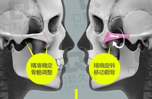北京圣嘉新张笑天改脸型磨骨价格