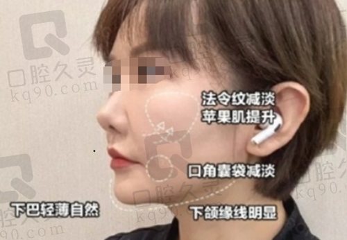北京艺美王东修复馒化脸怎么样？