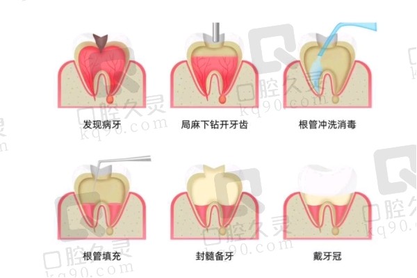 根管治疗一般能撑几年