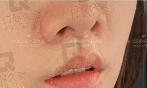 北京王晓健做人中缩短怎么样？