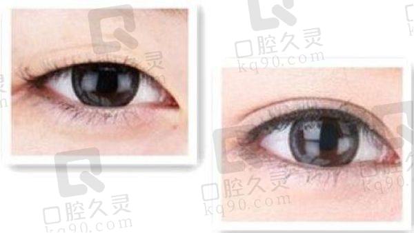 吕方中双眼皮怎么预约