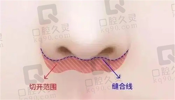 人中縮短