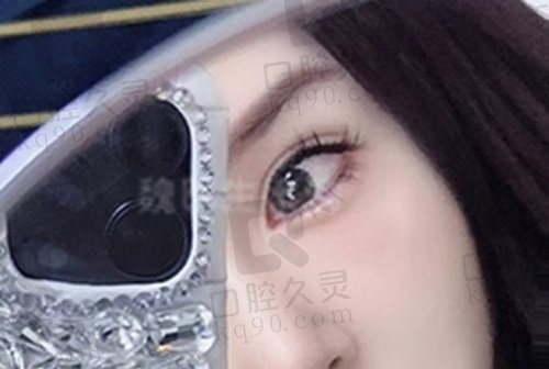 北京知音魏志香医生双眼皮技术怎么样？
