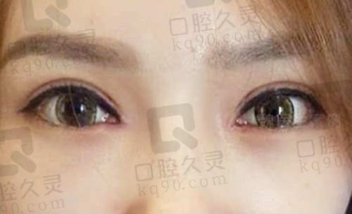 北京知音魏志香医生双眼皮技术怎么样？