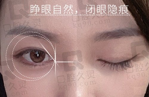 北京丰联丽格师丽丽双眼皮价格