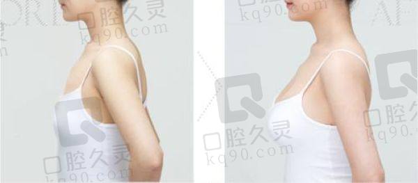 深圳藝星隆胸醫(yī)生哪個好