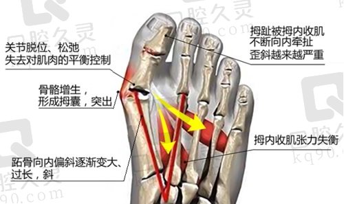 北京苏敬达医生拇外翻手术价格