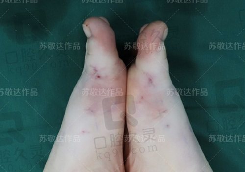 北京苏敬达医生大脚骨手术怎么样？