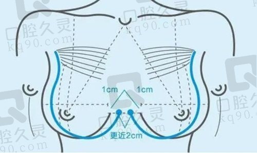 郑州市管城中医院整形科崔双全医生隆胸怎么样？