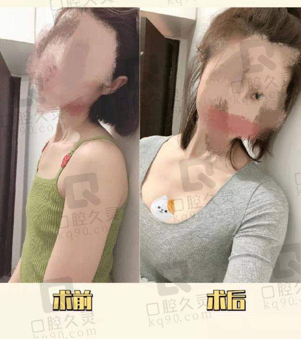 北京纯脂医院做自体脂肪丰胸多少钱