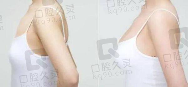 北京纯脂医院做自体脂肪丰胸怎么样