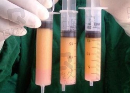 北京圣嘉新李春財擅長自體脂肪豐胸