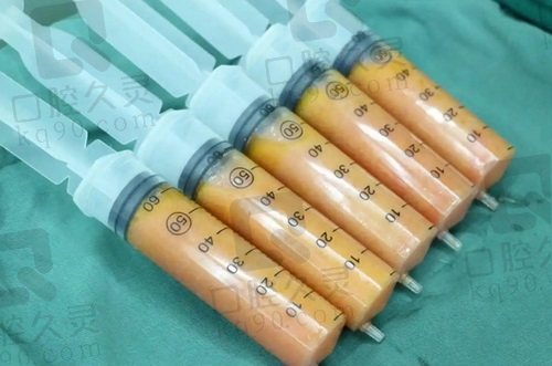 李朕醫(yī)生脂肪豐胸價格貴嗎？