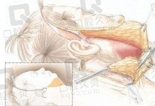 北京黄寺李晓东PST面部提升拉皮价格