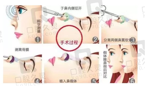 广州中家医易普锋做鼻子贵吗