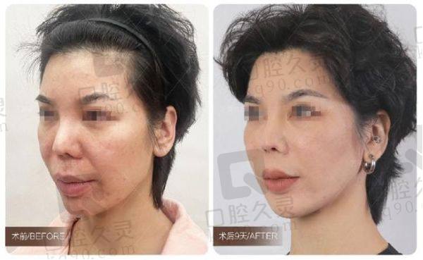北京王阔远治疗馒化苹果肌费用