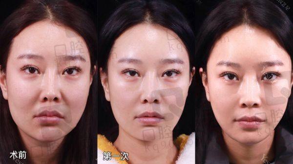 北京王阔远治疗馒化苹果肌怎么样