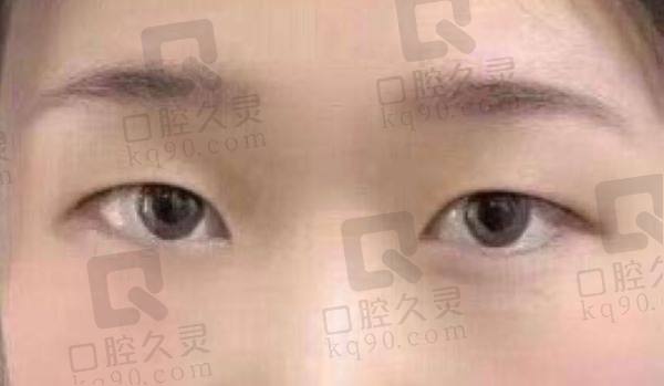 北京美莱整形医院做双眼皮怎么样