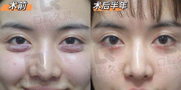 貴陽利美康祛眼袋醫(yī)生推薦