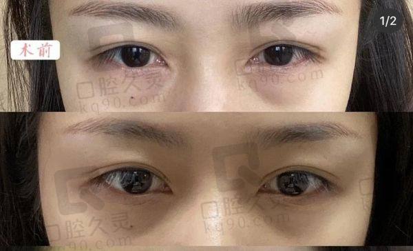 貴陽利美康祛眼袋價格