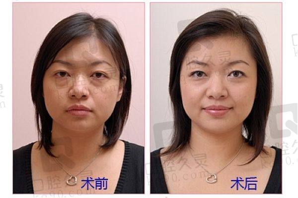 貴陽利美康祛眼袋預(yù)約流程