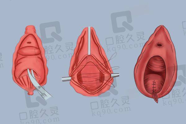 杭州做3d生物束带紧缩术的医院排名