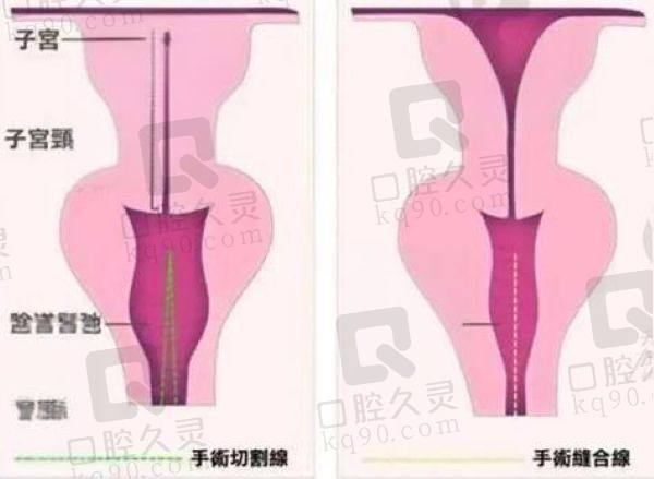 杭州做3d生物束带紧缩术的医院有哪些