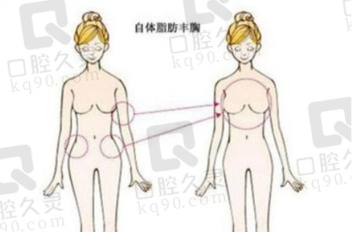 北京嘉禾赵希军院长脂肪丰胸