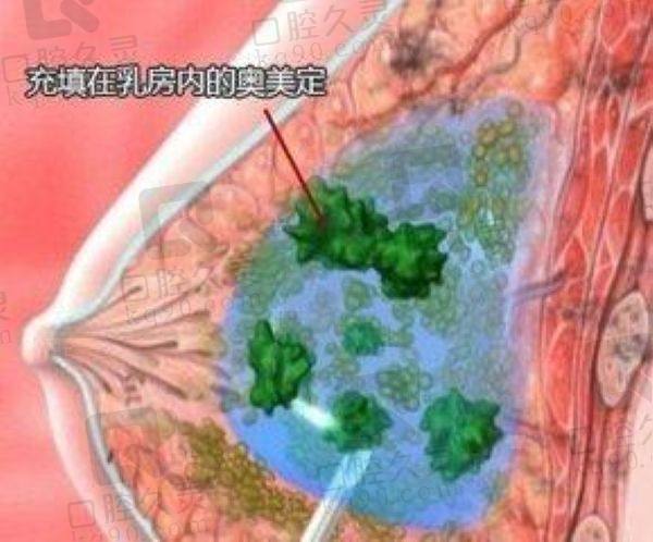 上海谢卫国医生隆胸怎么样