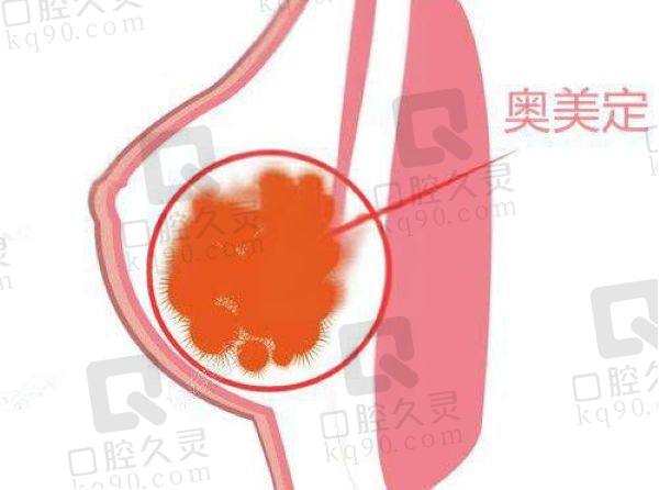 上海谢卫国注射隆胸取出技术怎么样